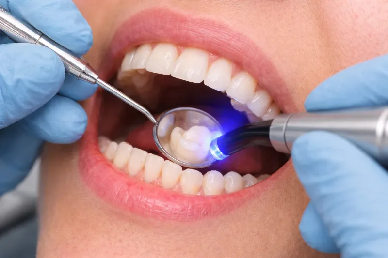 Tooth Fillings at Carewell Dental